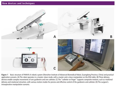Figure 1 Basic structure of PANVIS-A robotic system (Shenzhen Institute of Advanced Biomedical Robot, Guangdong Province, China) and practical application scenario. (A) The robot operates in a master–slave mode, with a master and a slave manipulator on the DSA table. (B) Three delivery devices enable complex movements of one guidewire and one catheter. (C) The “catheter on finger” supports composite motions, such as rotational delivery and rotational retraction, with various motion modes for precise and effective control of the guidewire and catheter. (D) The surgeon’s intraoperative manipulation scenario.