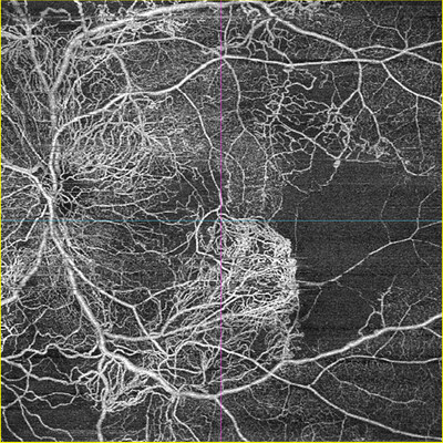 Carl_Zeiss_Meditec_AG_ZEISS_AngioPlex_OCT_Angiography Carl_Zeiss_Meditec_AG_ZEISS_AngioPlex_OCT_Angiography