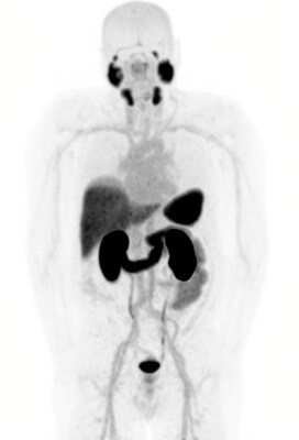 Lesion uptake of 64Cu-SAR-bisPSMA positron emission tomography (PET) at baseline (left image) and following two cycles of 67Cu-SAR-bisPSMA (8 GBq each; right image). PET image on the right was acquired 1 month after the 2nd cycle. Coloured arrows indicate representative metastatic bone lesions within each region: red – skull; blue – ribs and sternum; orange – spine; green – pelvis. Images shown as maximum intensity projections. Lesion uptake of 64Cu-SAR-bisPSMA positron emission tomography (PET) at baseline (left image) and following two cycles of 67Cu-SAR-bisPSMA (8 GBq each; right image). PET image on the right was acquired 1 month after the 2nd cycle. Coloured arrows indicate representative metastatic bone lesions within each region: red – skull; blue – ribs and sternum; orange – spine; green – pelvis. Images shown as maximum intensity projections.